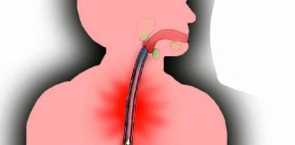 نسخه ای فوری و خانگی برای ریفلاکس معده0 (0) نسخه ای فوری و خانگی برای ریفلاکس معده