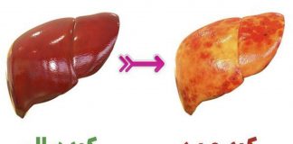 علائم کبد چرب که خیلی دیر نمایان می شوند0 (0) علائم کبد چرب