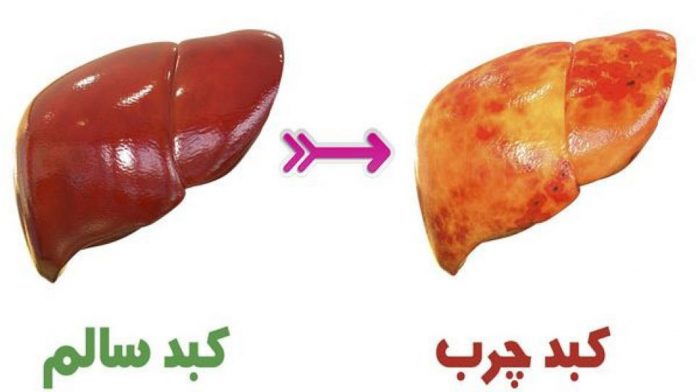 علائم کبد چرب