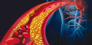 چجوری بفهمیم کلسترول خون داریم ؟0 (0) چجوری بفهمیم کلسترول خون داریم ؟