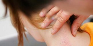 توصیه های کلیدی متخصصین پوست درباره بیماری اگزما0 (0) بیماری اگزما